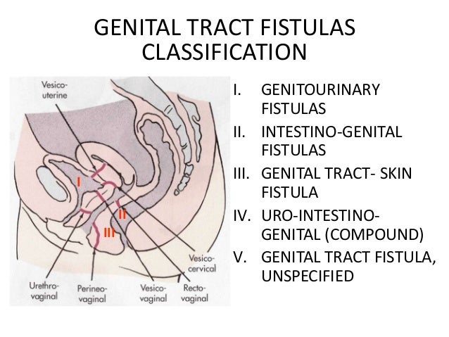 urethra vaginal fistula Anal picture ass
